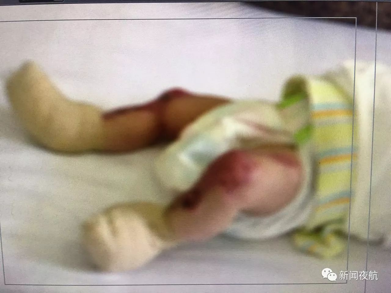 女婴罕见先天皮肤缺失 下肢双手肌肉暴露在外