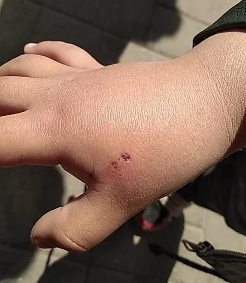 紧急求助山东5岁男孩被老鼠咬手急寻出血热疫苗