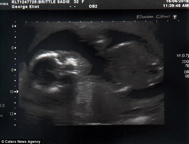 女子宫外孕流产3个月后发现肚里还有一个孩子