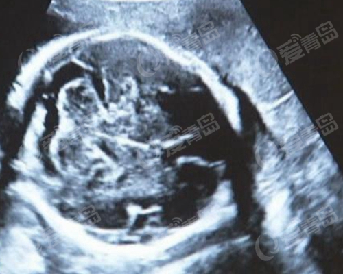 宝宝出生后肚脐鼓大包 一查竟是寄生胎
