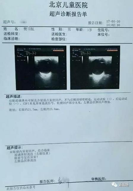 北京儿童医院超声诊断报告单显示:航航双眼球内异常回声,结合临床