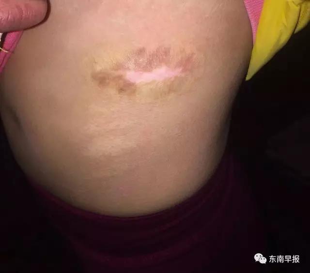 江西12岁女孩遭亲妈家暴手指被剪断身体被烫伤