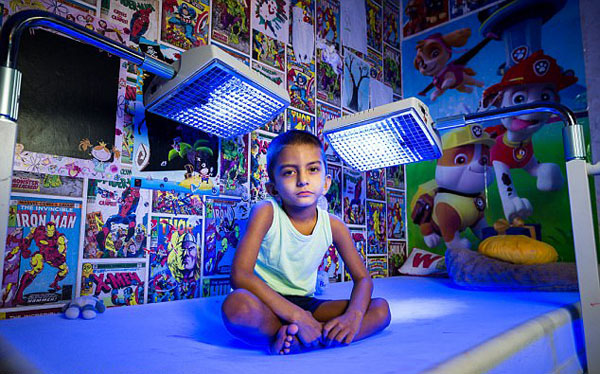 英国4岁男童患怪病 每天需蓝光照射20小时保命