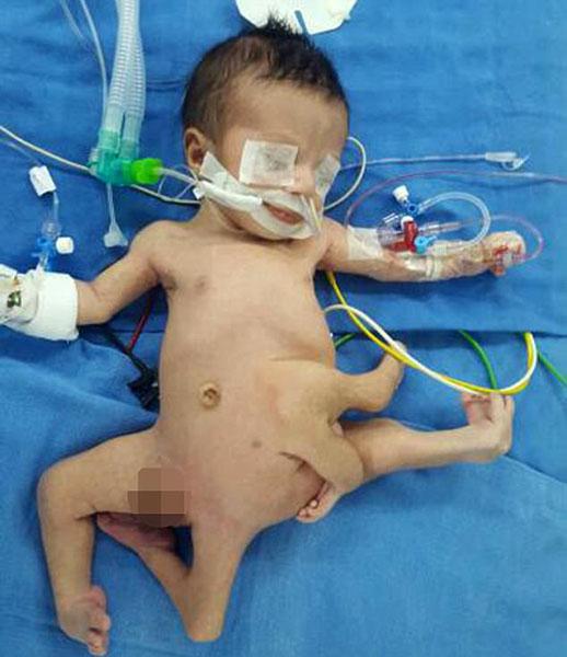 伊拉克婴儿患多肢畸形病 共长有8个肢体(图)
