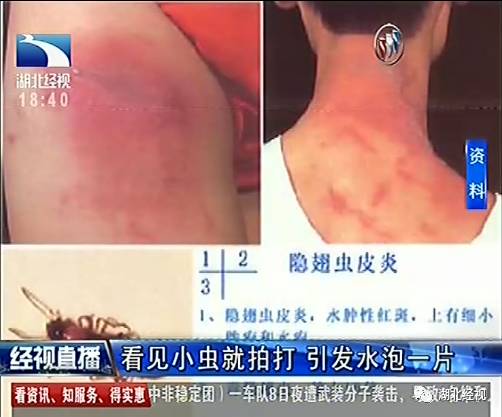武汉市第一医院皮肤科医师赵芬介绍，最近在皮肤科门诊，她一天能接诊到三四名隐翅虫皮炎的患者，不少都像刘小姐是睡觉起床后发现。