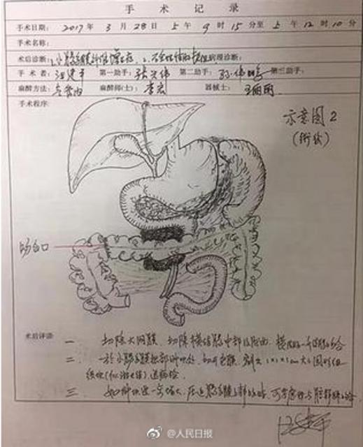 医生做8小时手术后不休息 画出详细手术图