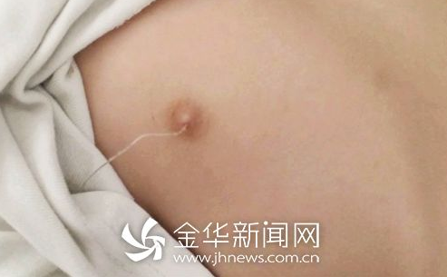 浙19个月大孩子脱衣时被发现缝衣针刺进乳头 