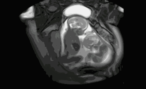 怀孕双胞胎b超图图片