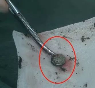 小女孩下体塞入异物流血不止隔了几天走路都不对劲了