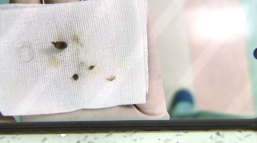 小女孩下体塞入异物流血不止隔了几天走路都不对劲了