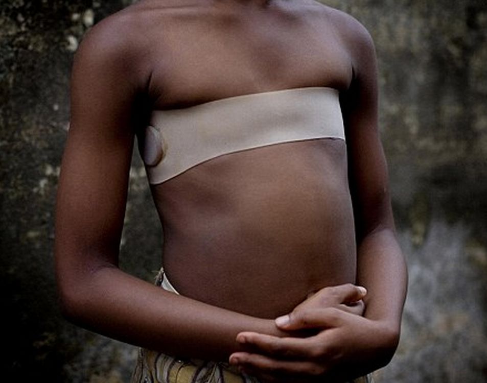 非洲以烫乳礼阻止女孩胸部发育 称为减少性侵