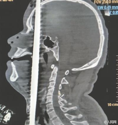 济南男子被钢筋从下体贯穿头顶 奇迹获救