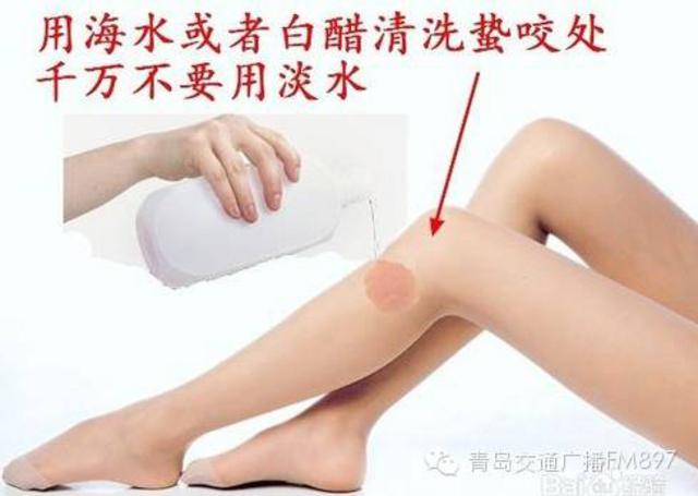 洗海澡被海蜇蜇伤应咋办?千万别用淡水冲(组图)