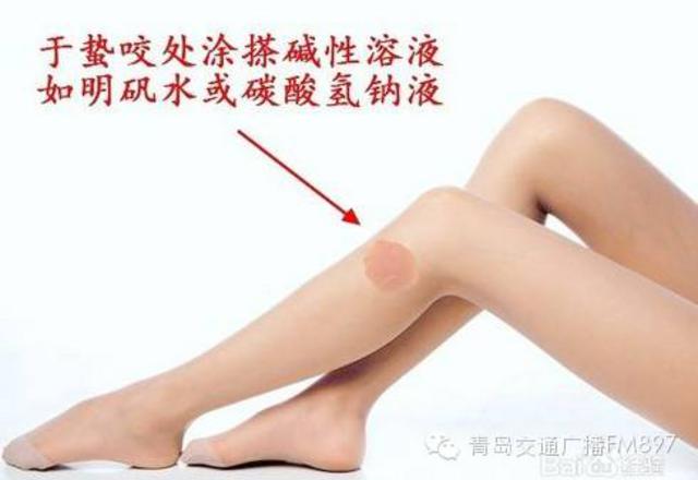 洗海澡被海蜇蜇伤应咋办?千万别用淡水冲(组图)