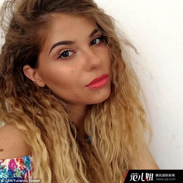 波兰美女全身长满数千胎记 大方晒照成网红