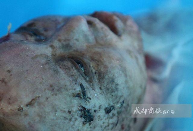 13岁少年为抢手机泼汽油烧伤年轻女教师