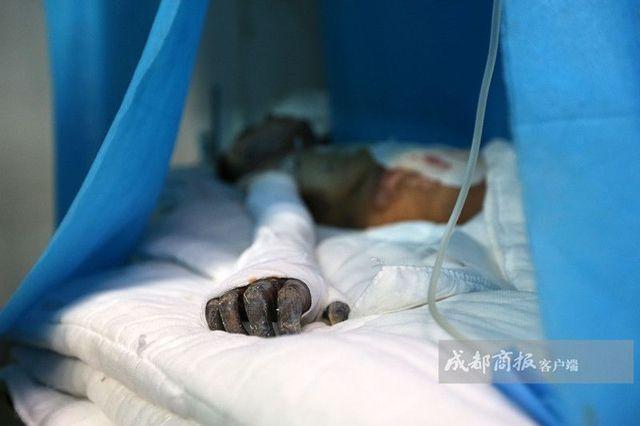 13岁少年为抢手机泼汽油烧伤年轻女教师