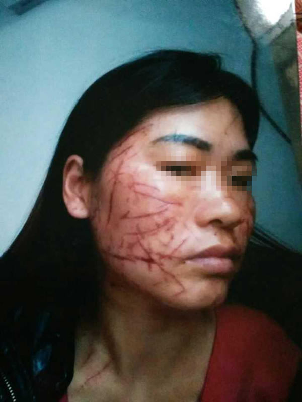 女子遭小三毁容 脸被锐器划100多刀