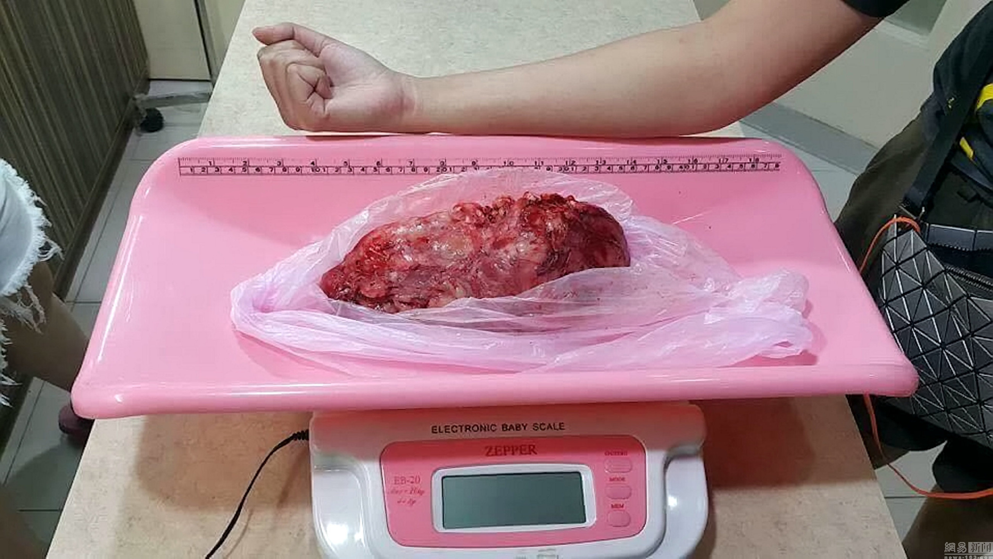 52公斤蟒蛇心脏肿瘤手术 成功切除1公斤肿瘤