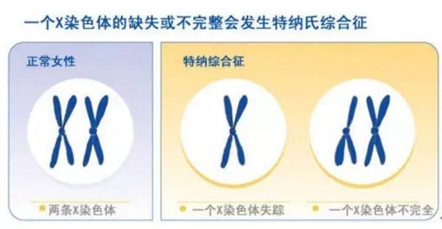 女子22岁从没来过例假 竟是少了一条X染色体 女子22岁从没来过例假 竟是少了一条X染色体