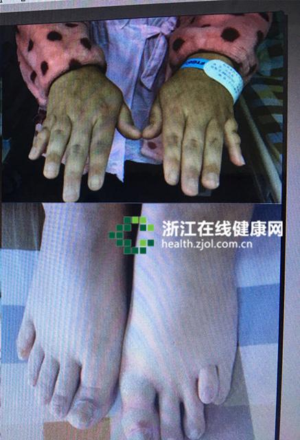 女子22岁从没来过例假 竟是少了一条X染色体 女子22岁从没来过例假 竟是少了一条X染色体