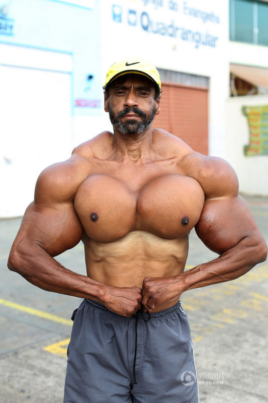巴西男子为健身向身体注射燃油 手臂粗60厘米