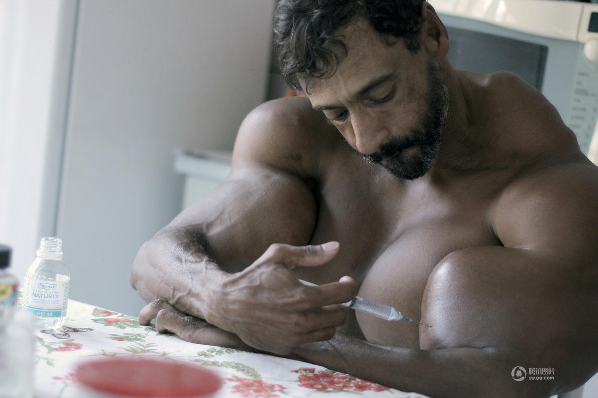 巴西男子为健身向身体注射燃油 手臂粗60厘米