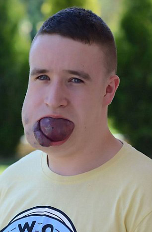 波兰男孩舌头上长肿瘤大如网球 危及生命(图)