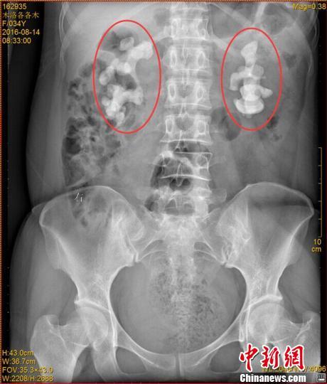四川女子喝生水30余年 双肾长10厘米巨型结石