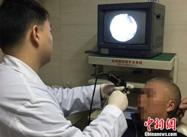 男子鼻腔频繁出血 就诊取出5厘米长蚂蝗（图）