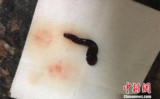 男子鼻腔频繁出血 就诊取出5厘米长蚂蝗（图）
