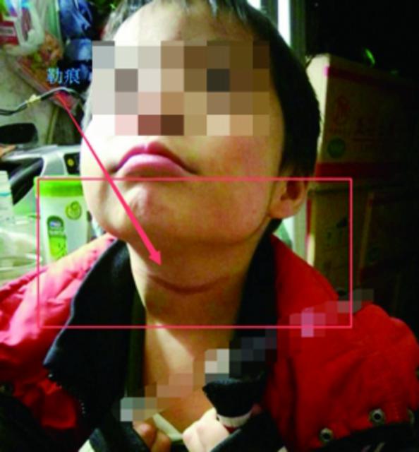 孩子脖子上的伤痕 网络图片