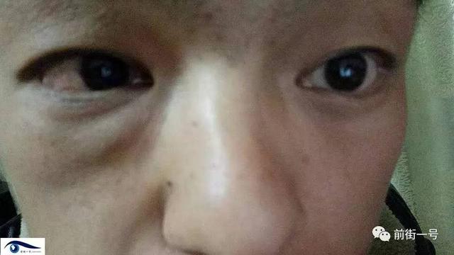 南通问题气体患者：微弱光感下，我们依然不知道注射气体的成分