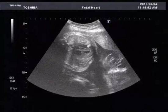 孕33周男宝睾丸b超图图片