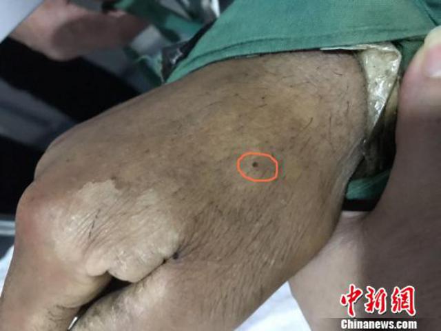 赵兴军(化名)右手背上的伤口。 梁辉 摄 赵兴军(化名)右手背上的伤口。 梁辉 摄
