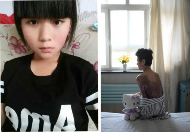 山东烧伤女孩刘振拍公益写真用笑容诠释涅槃重生