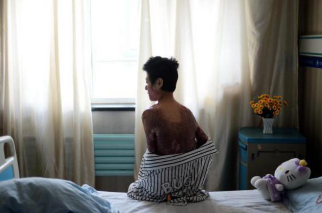 山东烧伤女孩刘振拍公益写真用笑容诠释涅槃重生