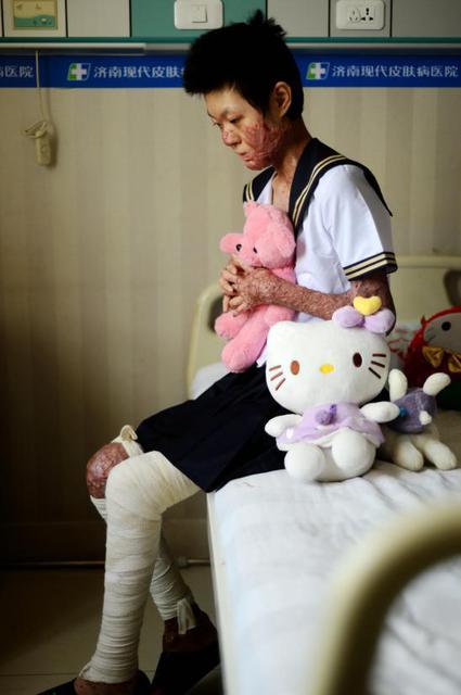 山东烧伤女孩刘振拍公益写真用笑容诠释涅槃重生