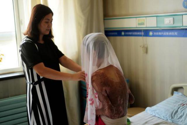 山东烧伤女孩刘振拍公益写真用笑容诠释涅槃重生