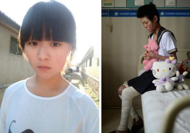 山东烧伤女孩刘振拍公益写真用笑容诠释涅槃重生