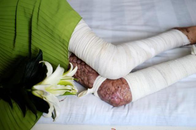 山东烧伤女孩刘振拍公益写真用笑容诠释涅槃重生