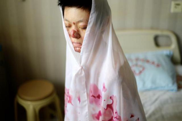 山东烧伤女孩刘振拍公益写真用笑容诠释涅槃重生