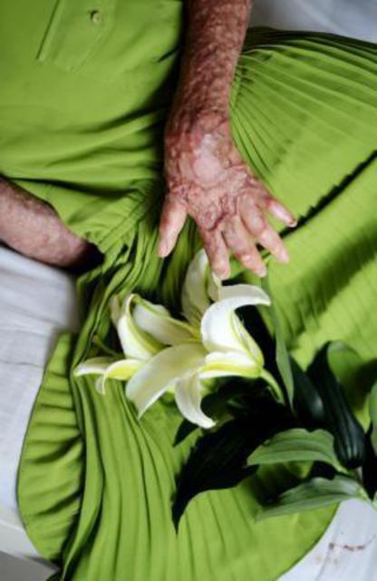 山东烧伤女孩刘振拍公益写真用笑容诠释涅槃重生