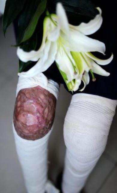 山东烧伤女孩刘振拍公益写真用笑容诠释涅槃重生