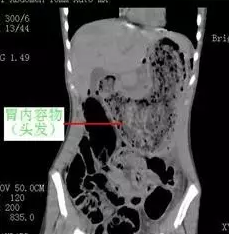 12岁女孩肚子痛就医 手术从胃里取出4斤头发