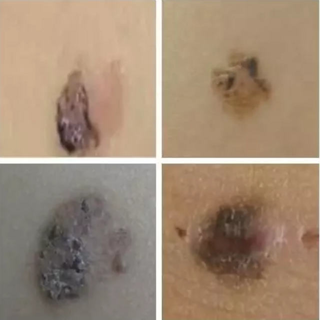 男子洗澡不慎搓破一颗痣 三年未治竟成癌(图)